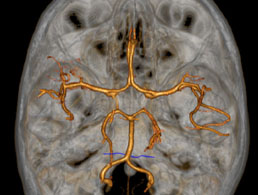 Perforante-de-l-AICA-et-de-la-PICA