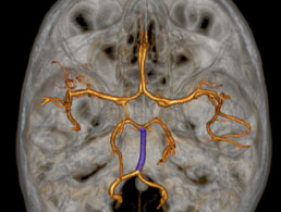 Perforante-du-sommet-du-tronc-basilaire-arteres-de-la-fossette-interpedonculaire
