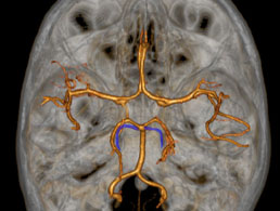 Perforante-de-l-artere-cerebelleuse-superieure-et-artere-colliculaire