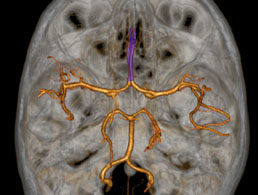Artere-cerebrale-anterieure-ACA