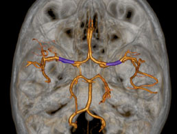 Perforante-de-M1-ACM-ou-artere-lenticulo-striee