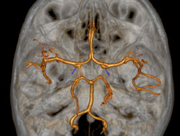 Artere-choroidienne-anterieure