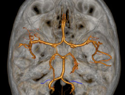 Perforante-de-la-PICA